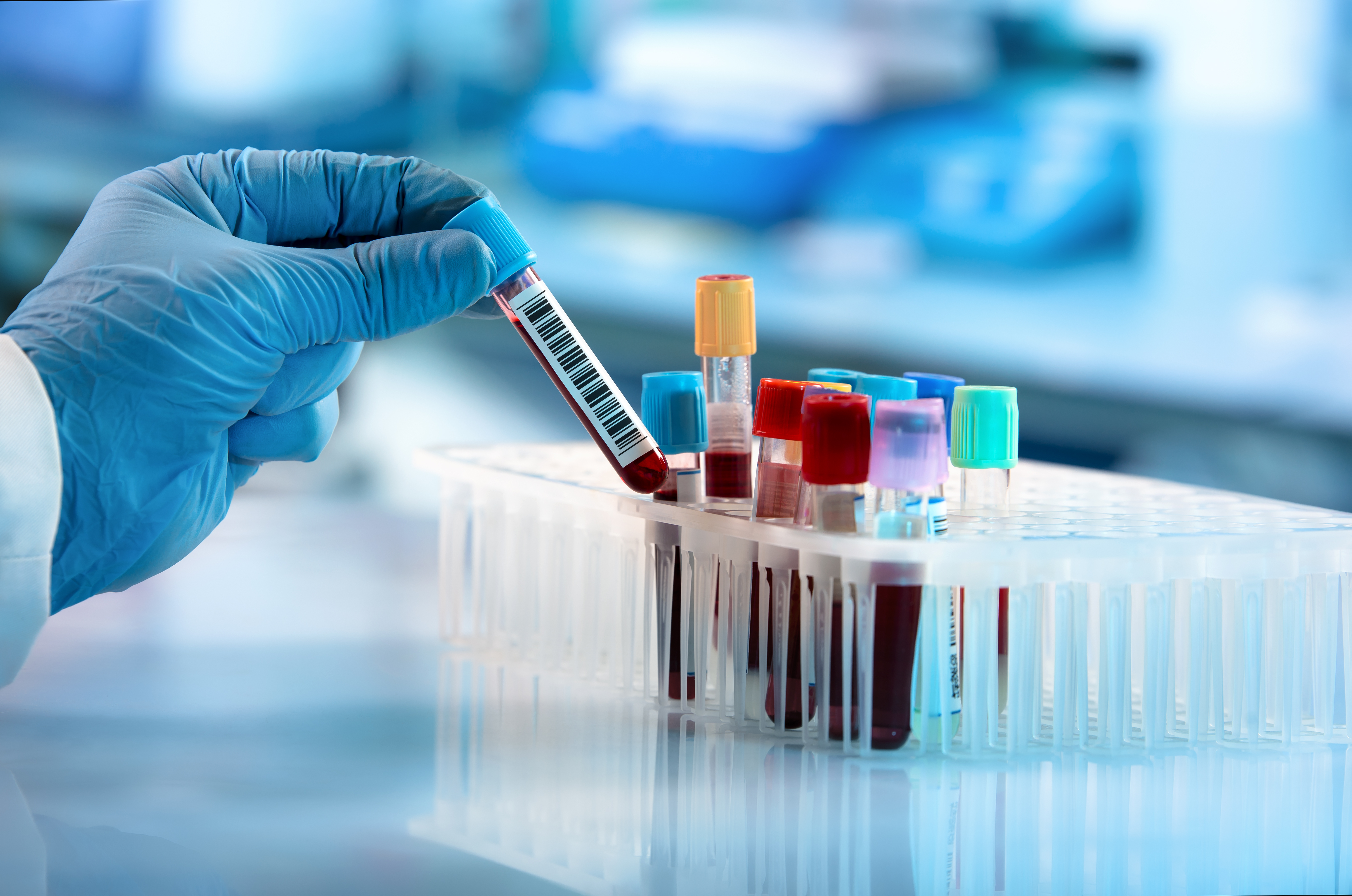 Doctor,hand,taking,a,blood,sample,tube,from,a,rack